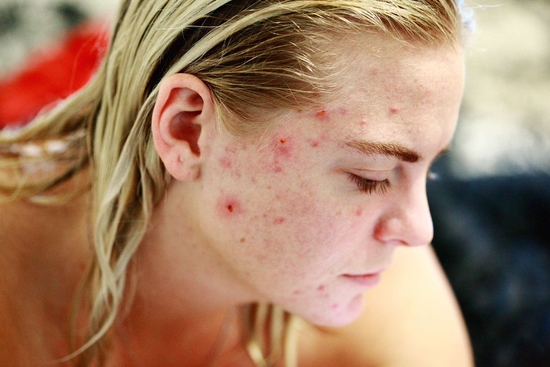 Le traitement courant de l'acné chez les adolescents peut avoir des effets à long terme sur le système squelettique : étude