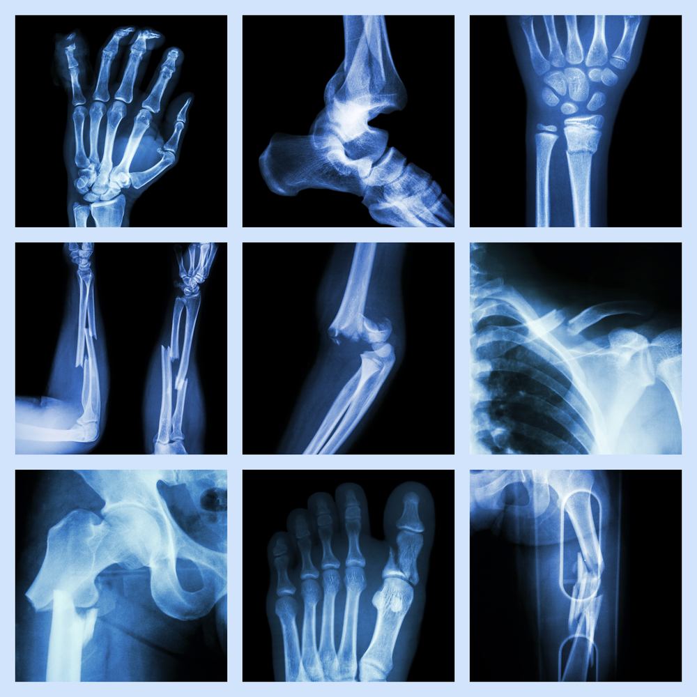 Study Finds This Vitamin Reduces Risk Of Bone Fracture, And It’s Not Vitamin D